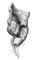 view M0019678: Illustration of a caecum with vermiform appendix and terminal portion of the ileum, 1922