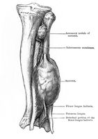 view M0019640: Illustration of a spindle-cell sarcoma of the fibula, 1917