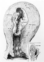 view M0019653: Illustration of a section of the uterus from which a sloughing fibroid had been removed, 1917