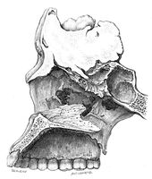 view M0019660: Illustration of an osteoma of the frontal sinus shown in section, 1922