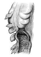 view M0019677: Illustration of a constricting cancer of the pelvic colon, 1922