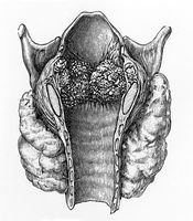 view M0019672: Illustration of the larynx of a child showing warts, 1922