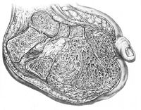 view M0019635: Illustration of a lipoma of the sole, 1917