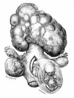 view M0019650: Illustration of a pregnant uterus with subserous fibroids, 1917