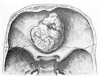 view M0019659: Illustration of the anterior fossae of the skull showing an osteoma arising in the left frontal sinus, 1922
