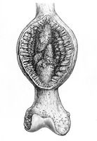 view M0019639: Illustration of a periosteal sarcoma of the femur, 1917