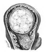 view M0019658EA: Illustration of lipoma arborescens of the shoulder joint, 1922